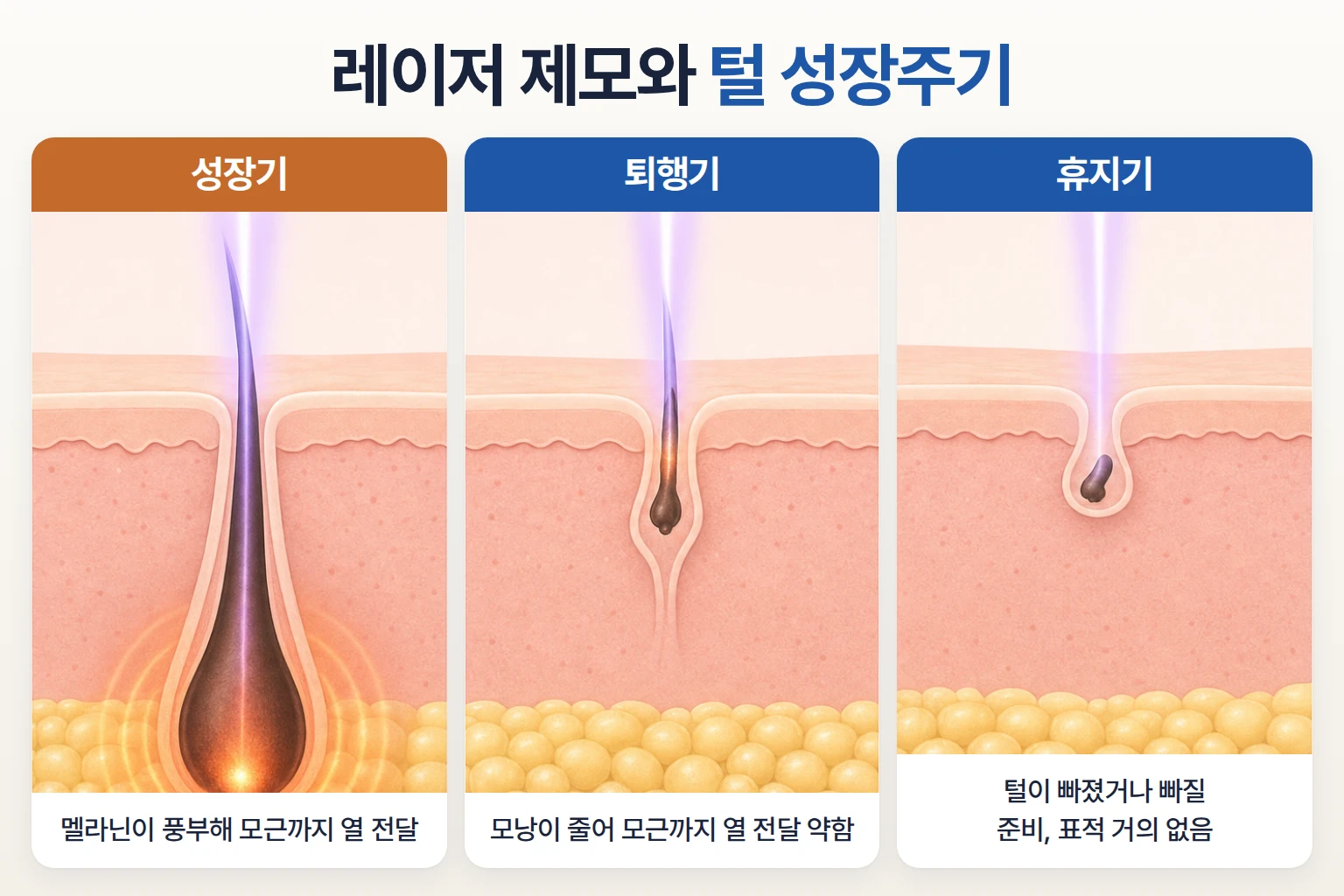 성장기, 퇴행기, 휴지기 모낭에 레이저 열이 전달되는 정도를 단계별로 비교한 단면 일러스트