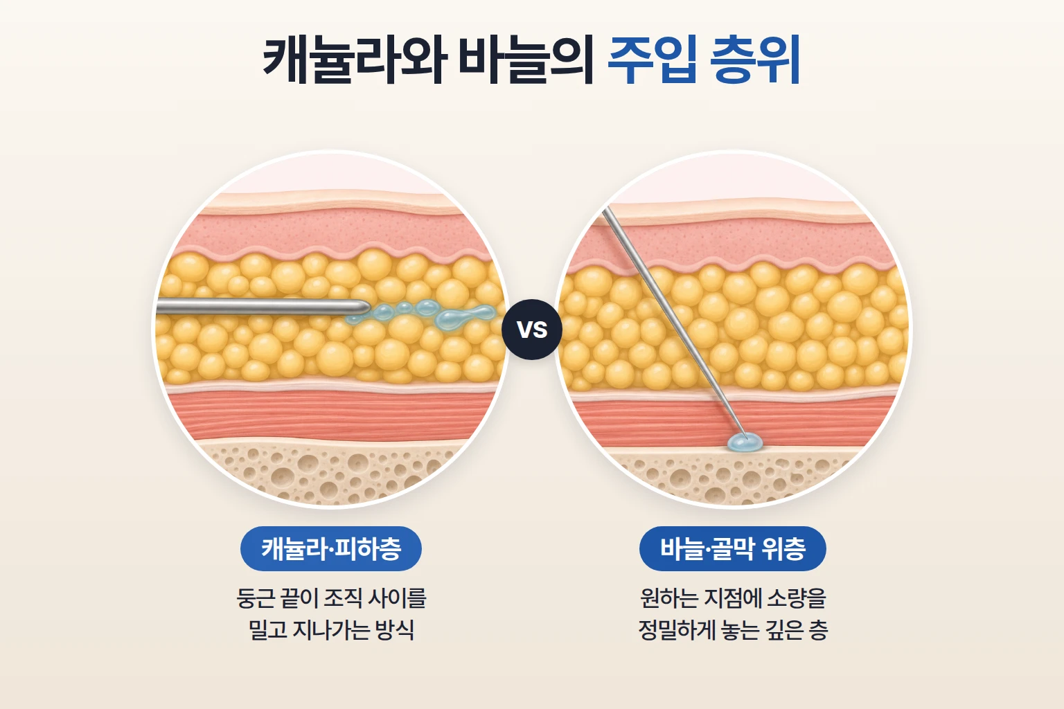 끝이 뭉툭한 캐뉼라의 피하층 주입과 바늘의 골막 위층 주입 깊이를 비교한 피부 단면도