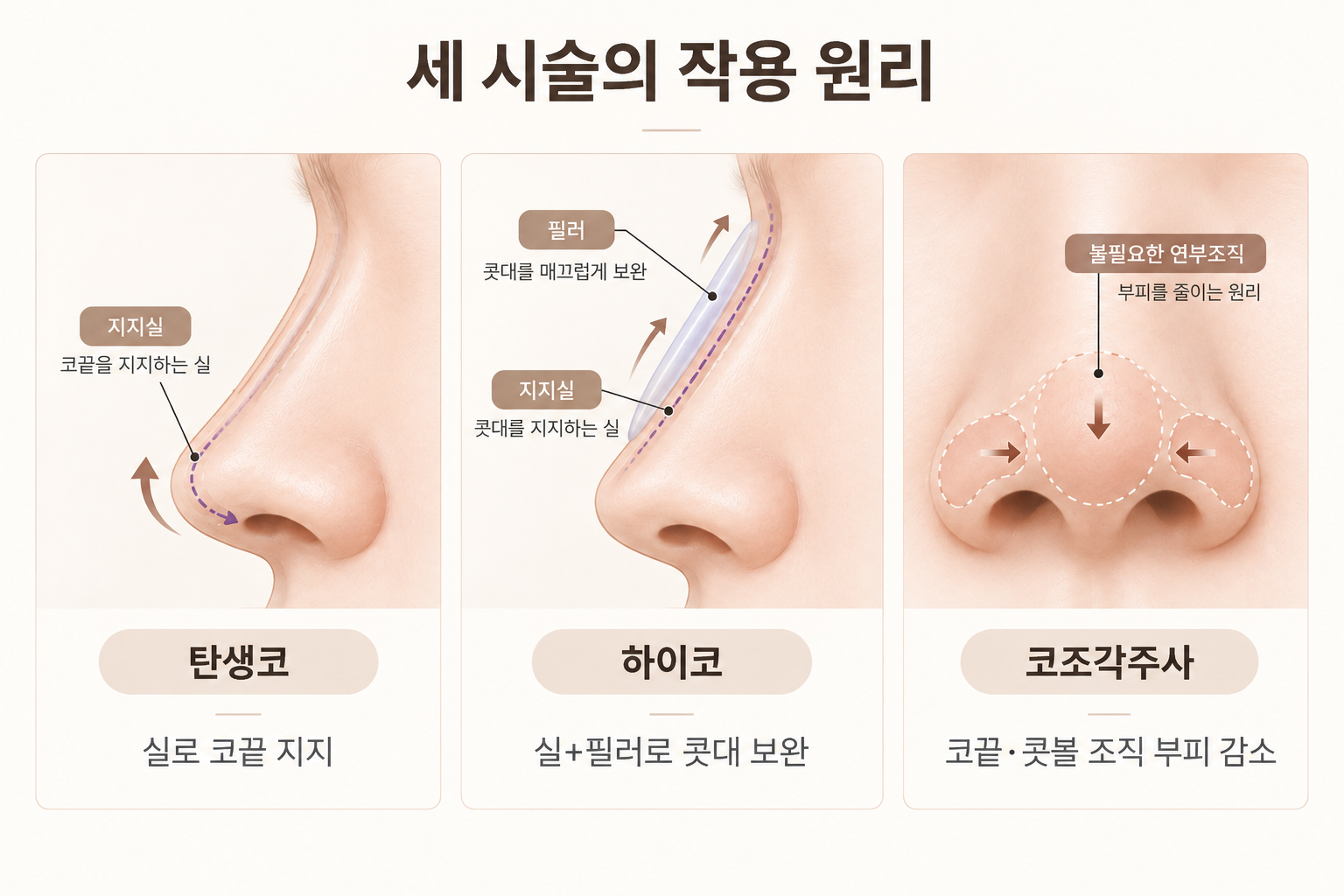 탄생코 실 지지 하이코 실 필러 결합 코조각주사 연부조직 감소 원리
