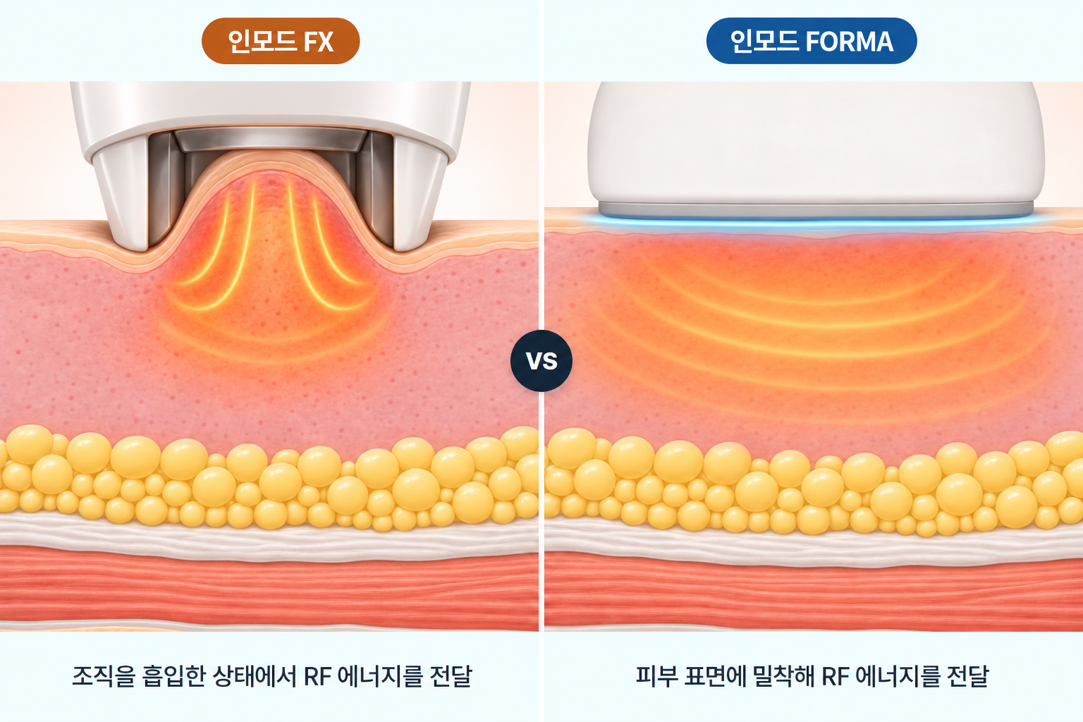 인모드 FX의 조직 흡입 RF와 FORMA의 피부 표면 밀착 RF 전달 비교