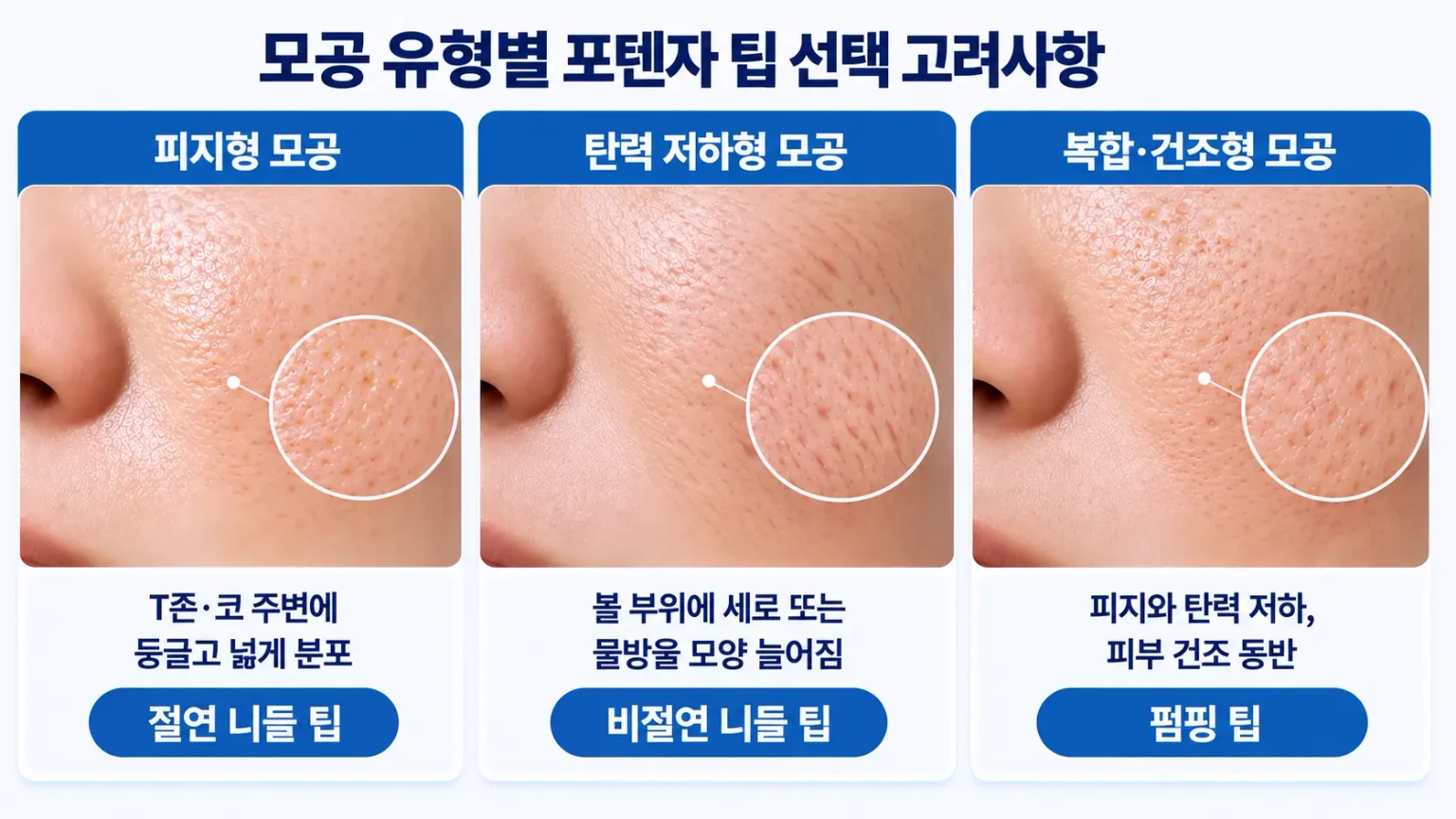 피지형 모공, 탄력 저하형 모공, 복합형 모공의 피부 특징과 포텐자 팁 선택 시