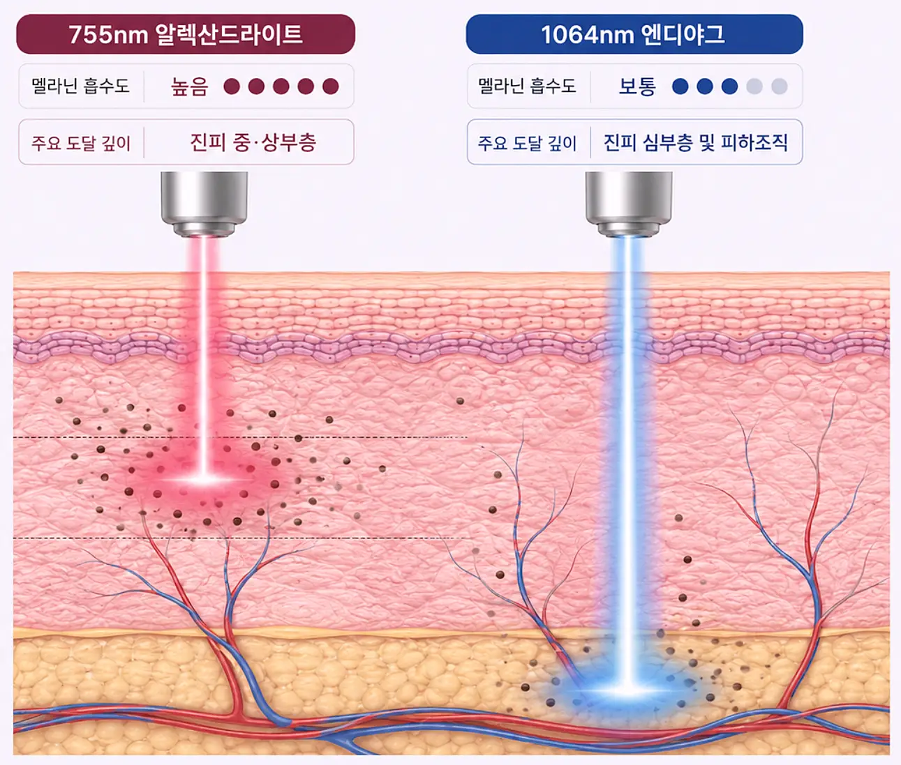 755nm 알렉산드라이트와 1064nm 엔디야그 파장 비교 - 도달 깊이와 멜라닌 흡수도