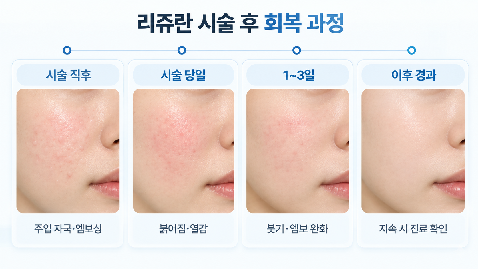 리쥬란 시술 직후 엠보싱과 붉어짐부터 1~3일 전후 붓기 완화 및 이후 피부 회복 경과