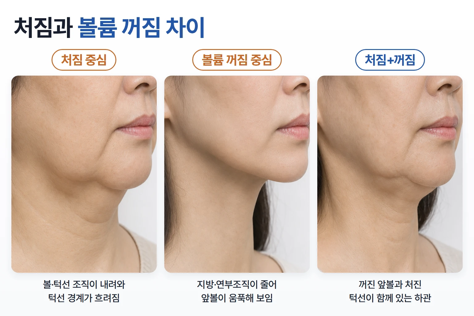 볼과 턱선이 내려온 처짐, 앞볼이 꺼진 볼륨 감소, 두 변화가 섞인 하관의 측면 비교 사진