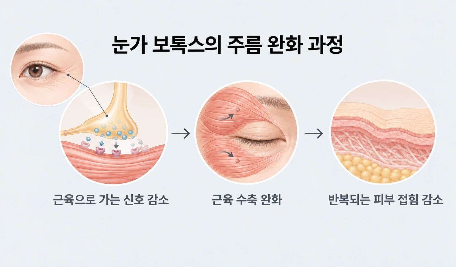 근육으로 가는 신호를 줄여 반복되는 눈가 피부 접힘을 완화하는 보톡스 원리