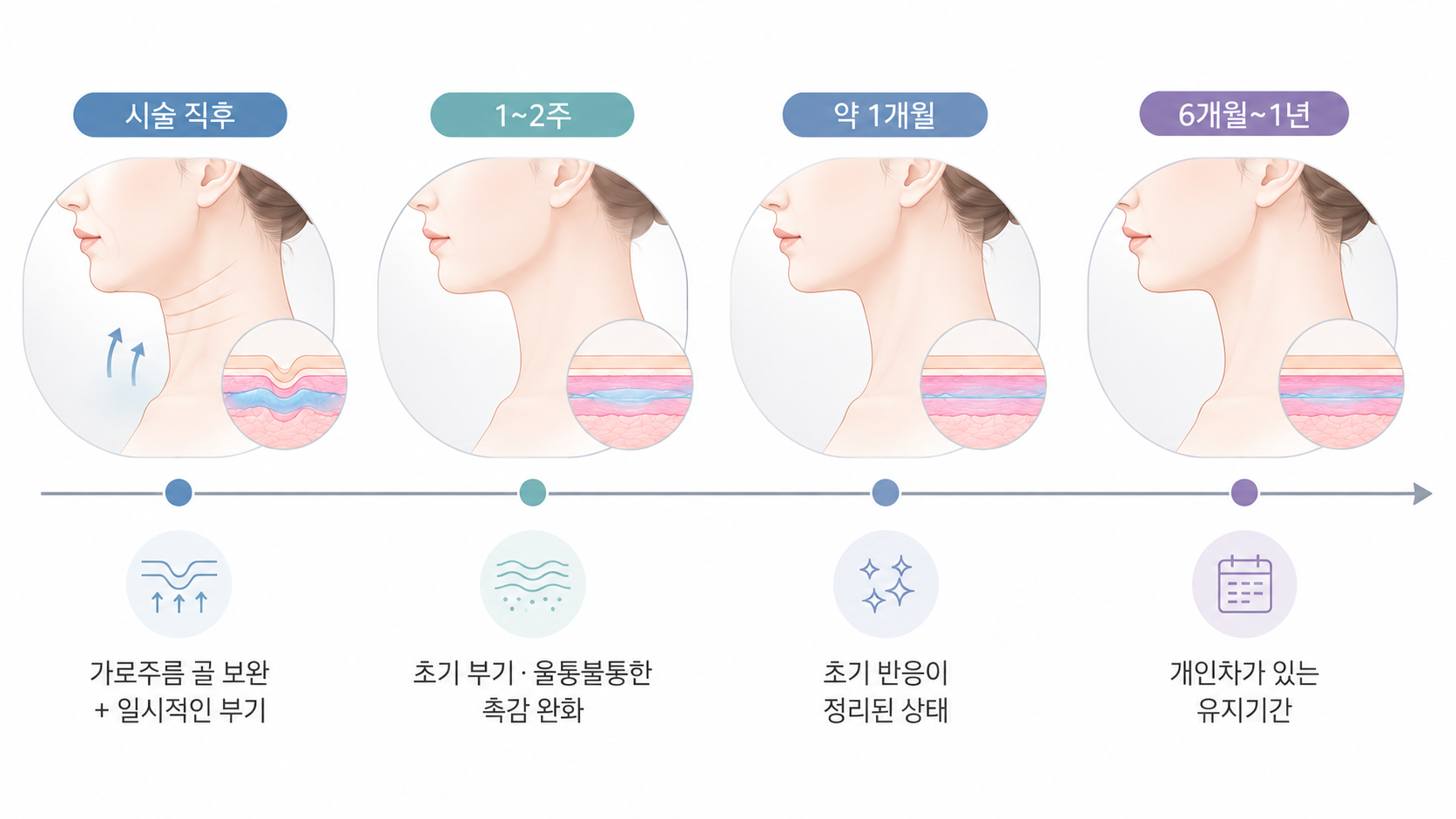 목주름 필러 시술 직후부터 6개월에서 1년까지의 변화 시점을 정리한 타임라인