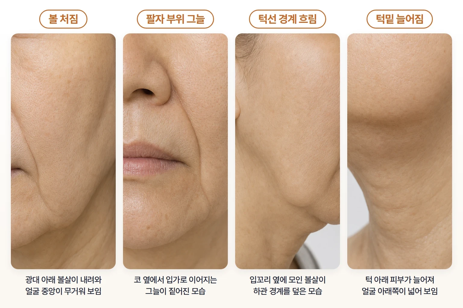 볼 처짐, 팔자 부위 그늘, 흐려진 턱선 경계와 턱밑 피부 늘어짐을 나란히 비교한 네 부위