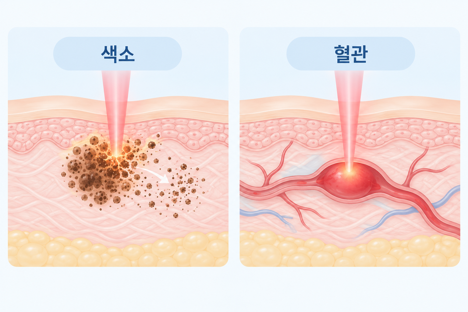 기미·잡티 색소 레이저와 안면홍조 혈관 레이저의 작용 원리 비교 단면도