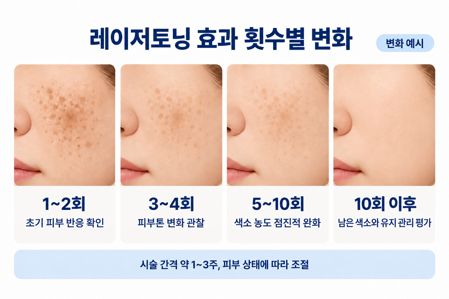 레이저토닝 시술 횟수에 따른 기미 색소의 점진적인 변화 예시