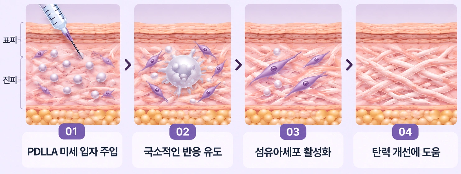 쥬베룩 PDLLA 미세 입자 주입부터 조직 반응, 섬유아세포 활성화, 탄력 개선까지 4단계 과정을 나타낸 피부 단면도