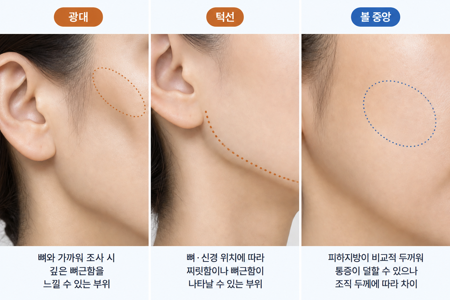 울쎄라 부위별 통증 차이에 영향을 주는 광대의 뼈 위치, 턱선의 신경 분포, 볼 중앙의 피하지방 두께 비교