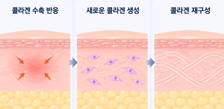 열 자극 후 콜라겐 수축과 새로운 콜라겐 생성, 재구성 과정을 단계별로 나타낸 피부 단면 모식도