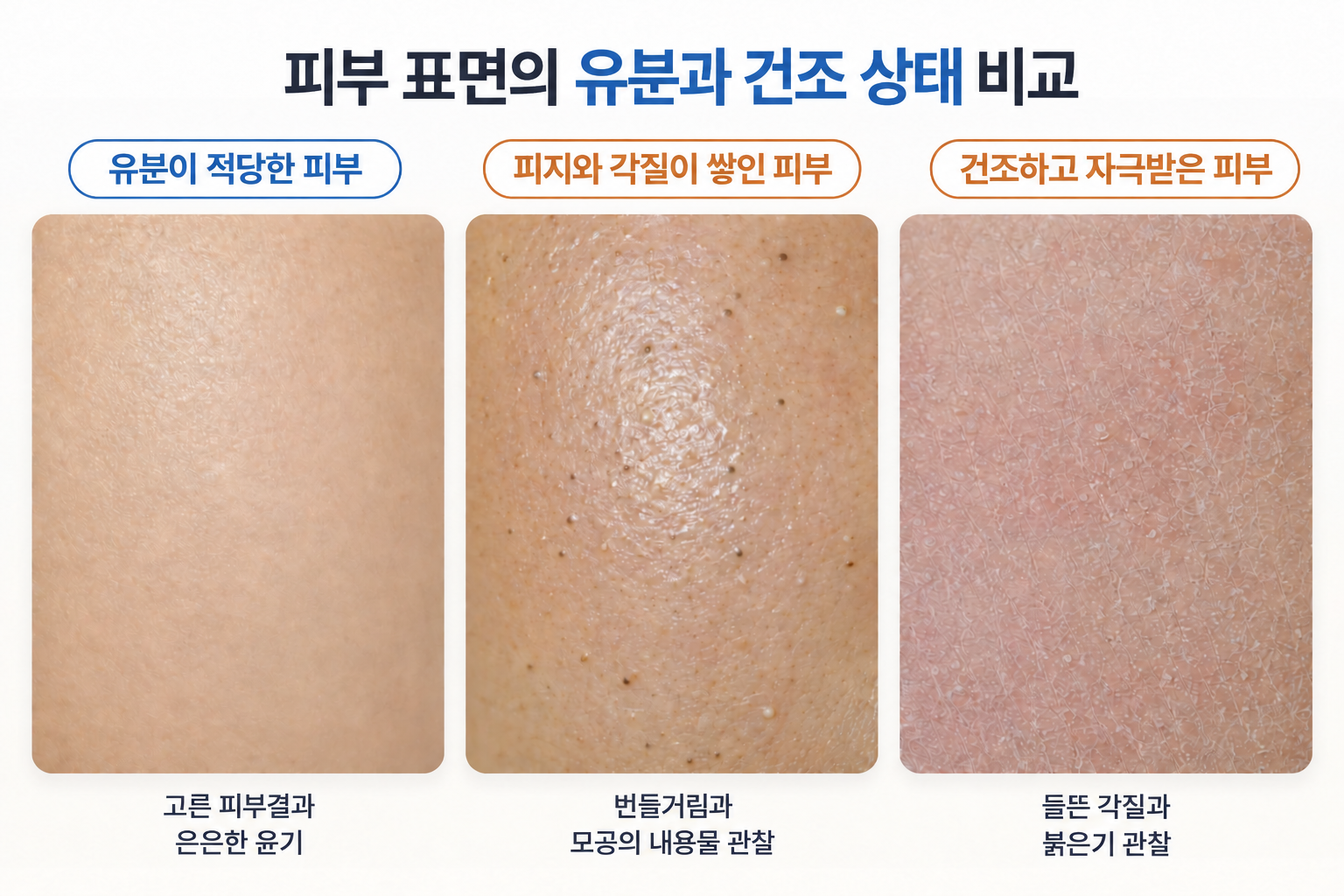 피지 분비와 피부 상태를 구분하기 위한 적정 유분 피부, 피지와 각질이 쌓인 모공, 건조하고 각질이 들뜬 피부 표면의 비교