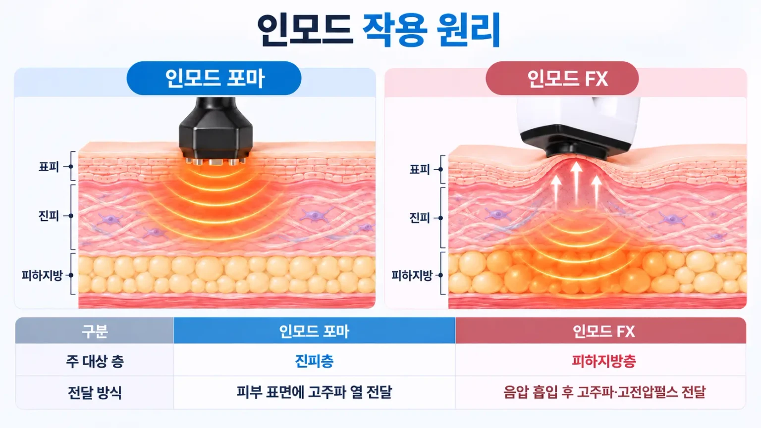 인모드 포마와 인모드 FX의 작용 원리 및 차이를 비교한 피부 단면 의료 일러스트. 포마는 진피층에