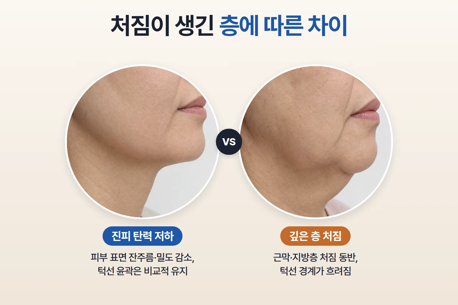 진피 탄력 저하형 처짐과 근막·지방층 처짐이 함께 있는 하관 측면 윤곽을 나란히 놓은 비교 사진