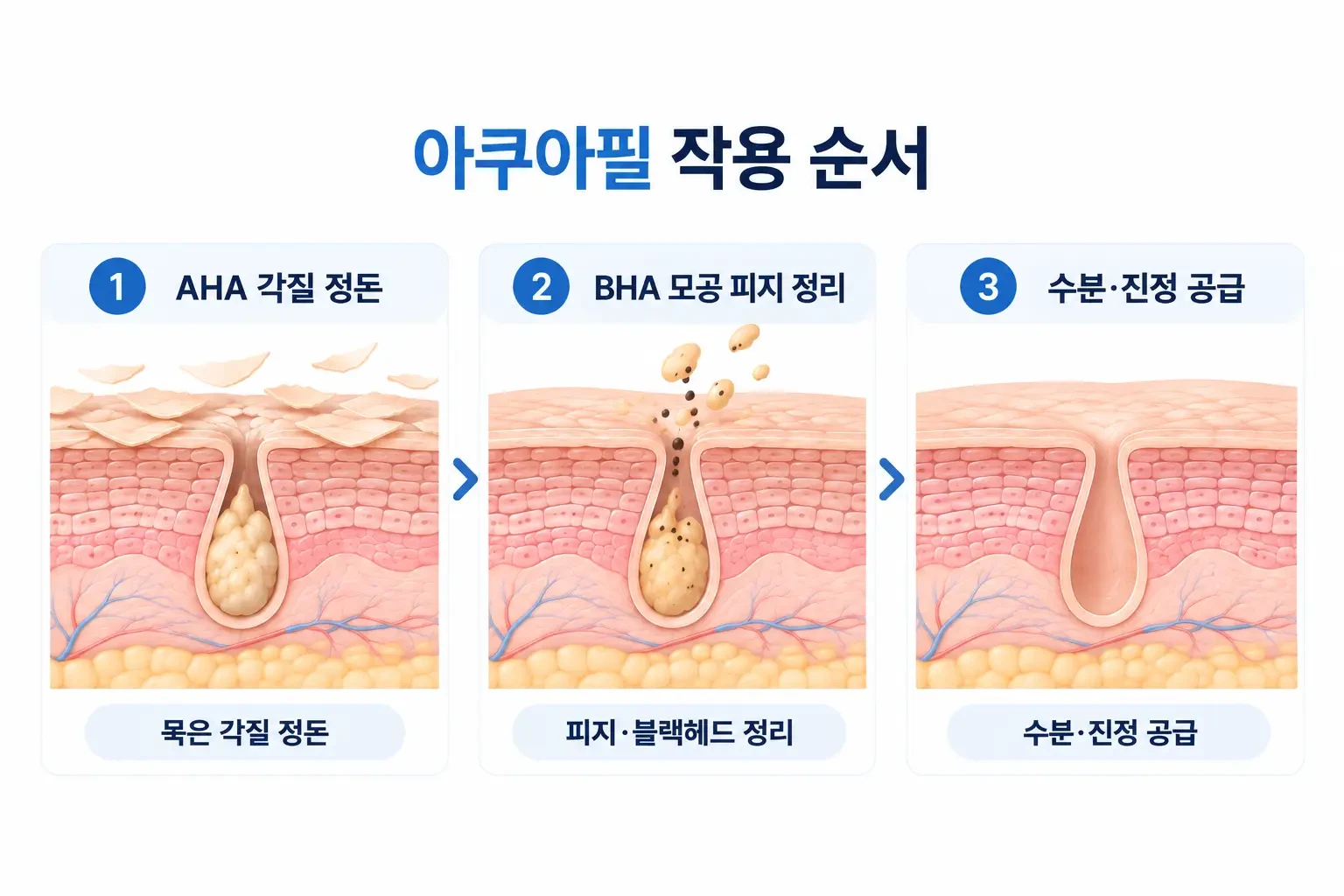 AHA 각질 정돈, BHA 모공 피지 정리, 수분·진정 공급으로 이어지는 아쿠아필 작용 단계 흐름