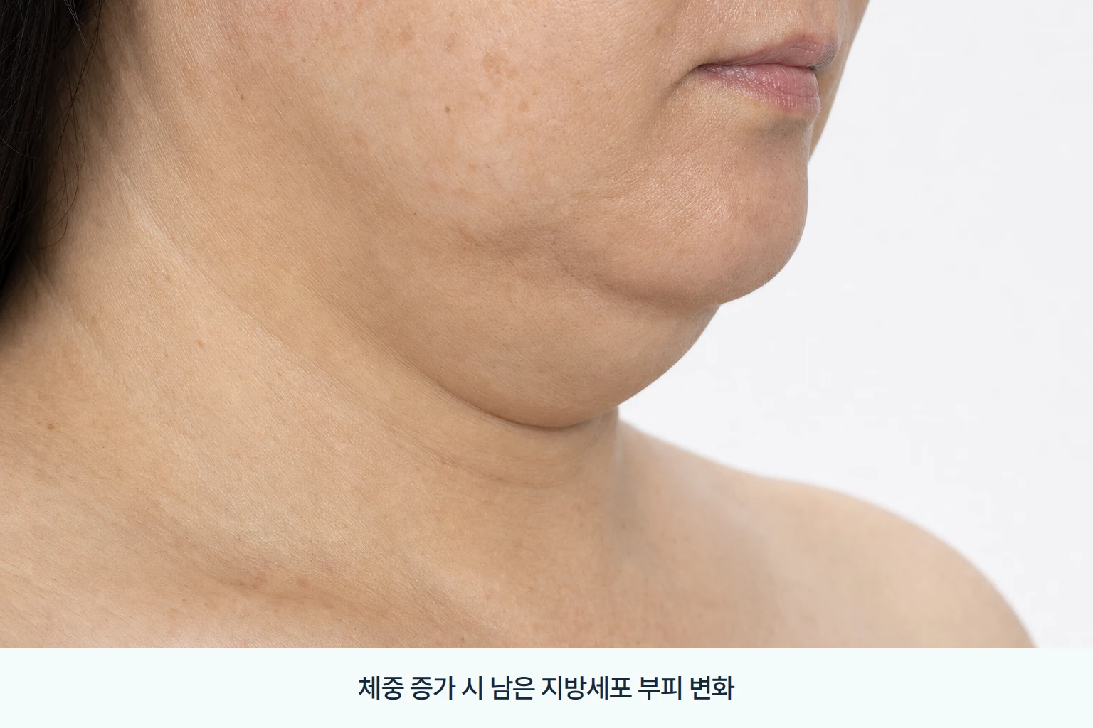 턱밑과 턱선 부위의 두께 변화를 관찰하기 위해 동일 각도로 가까이 담은 시술 부위 크롭 사진