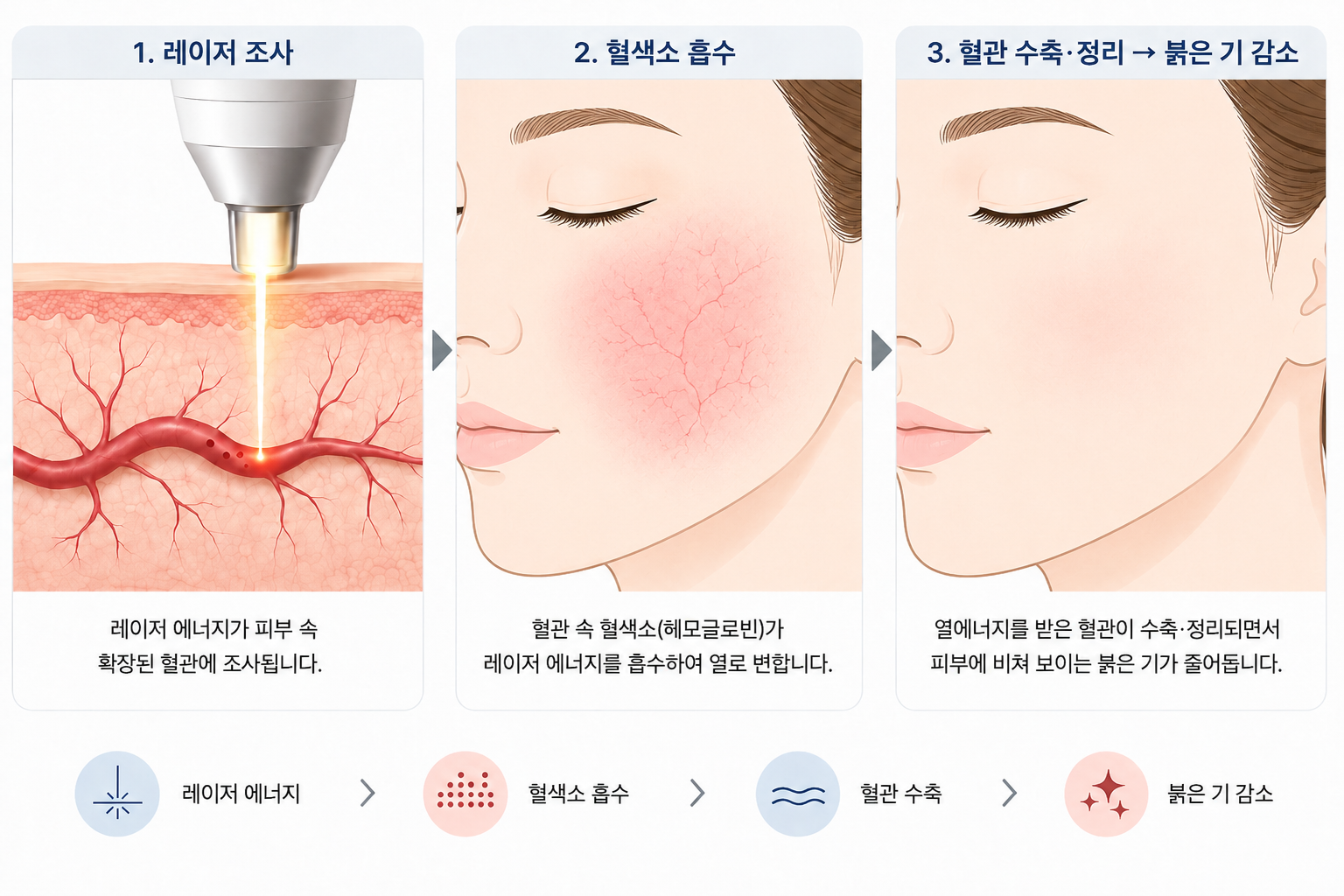 레이저 에너지의 혈색소 흡수와 열 전달 후 확장 혈관이 수축되는 혈관 치료 원리