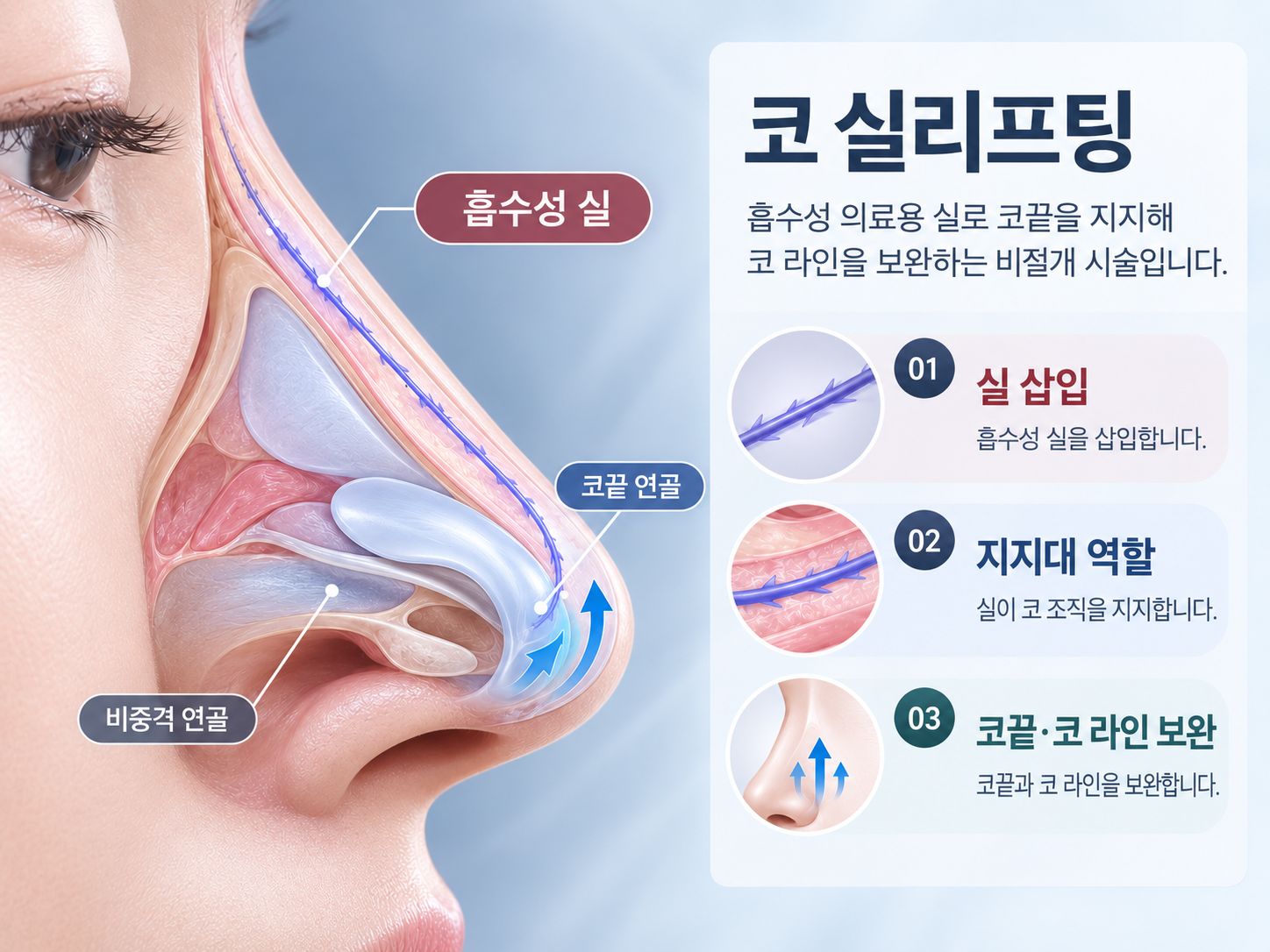 코 조직 내부의 흡수성 실이 코끝과 콧대 라인을 지지하는 코 실리프팅 원리