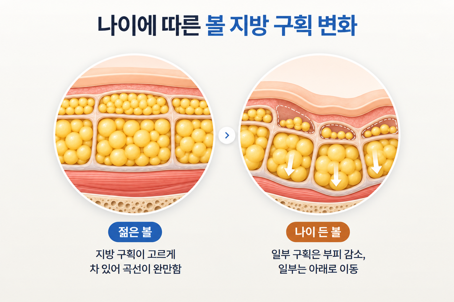 노화에 따라 일부 볼 지방 구획의 부피가 줄고 아래로 이동하는 변화
