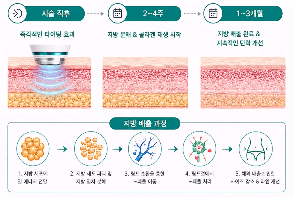 온다리프팅 효과 시점 타임라인 - 시술 직후부터 1~3개월까지