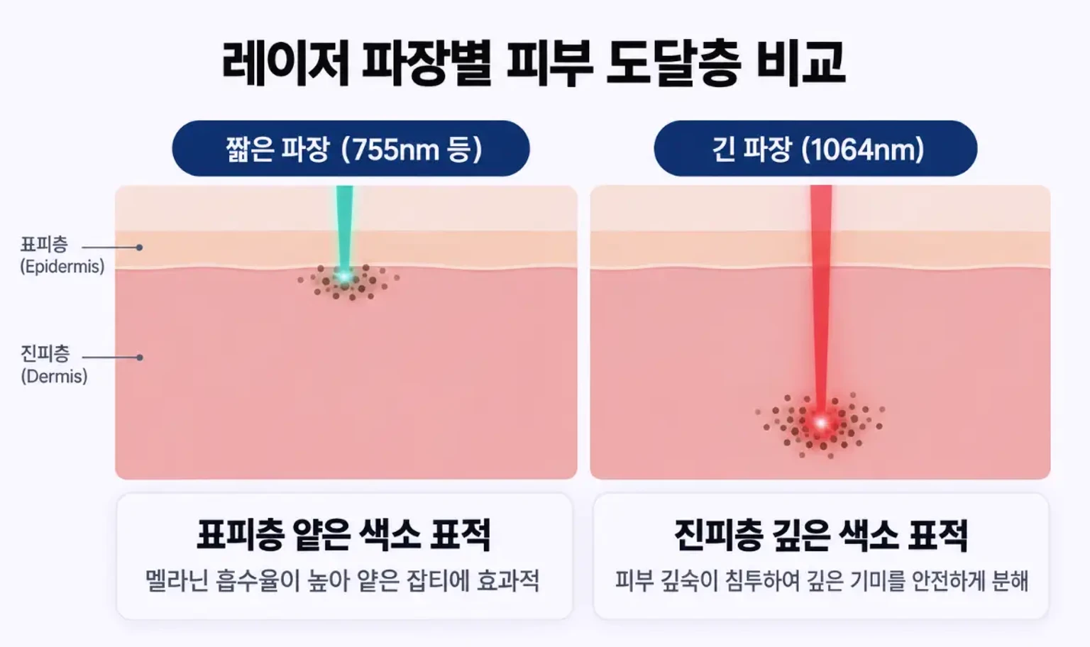 짧은 파장과 1064nm 파장이 표피와 진피에 도달하는 깊이를 나타낸 설명용 일러스트