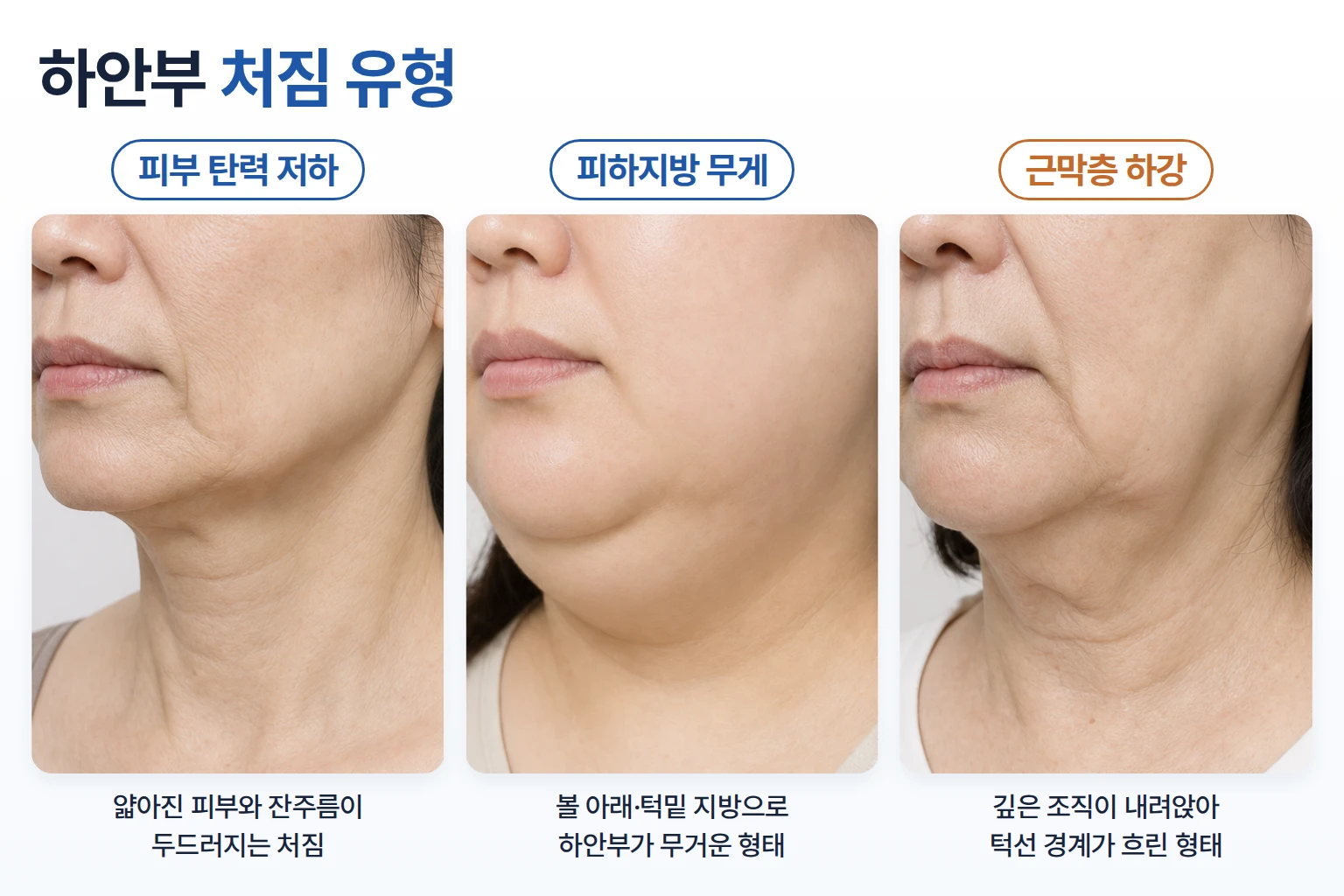 피부 탄력 저하, 피하지방 무게, 근막층 하강에 따른 얼굴 하안부 처짐 유형을 비교한 사진