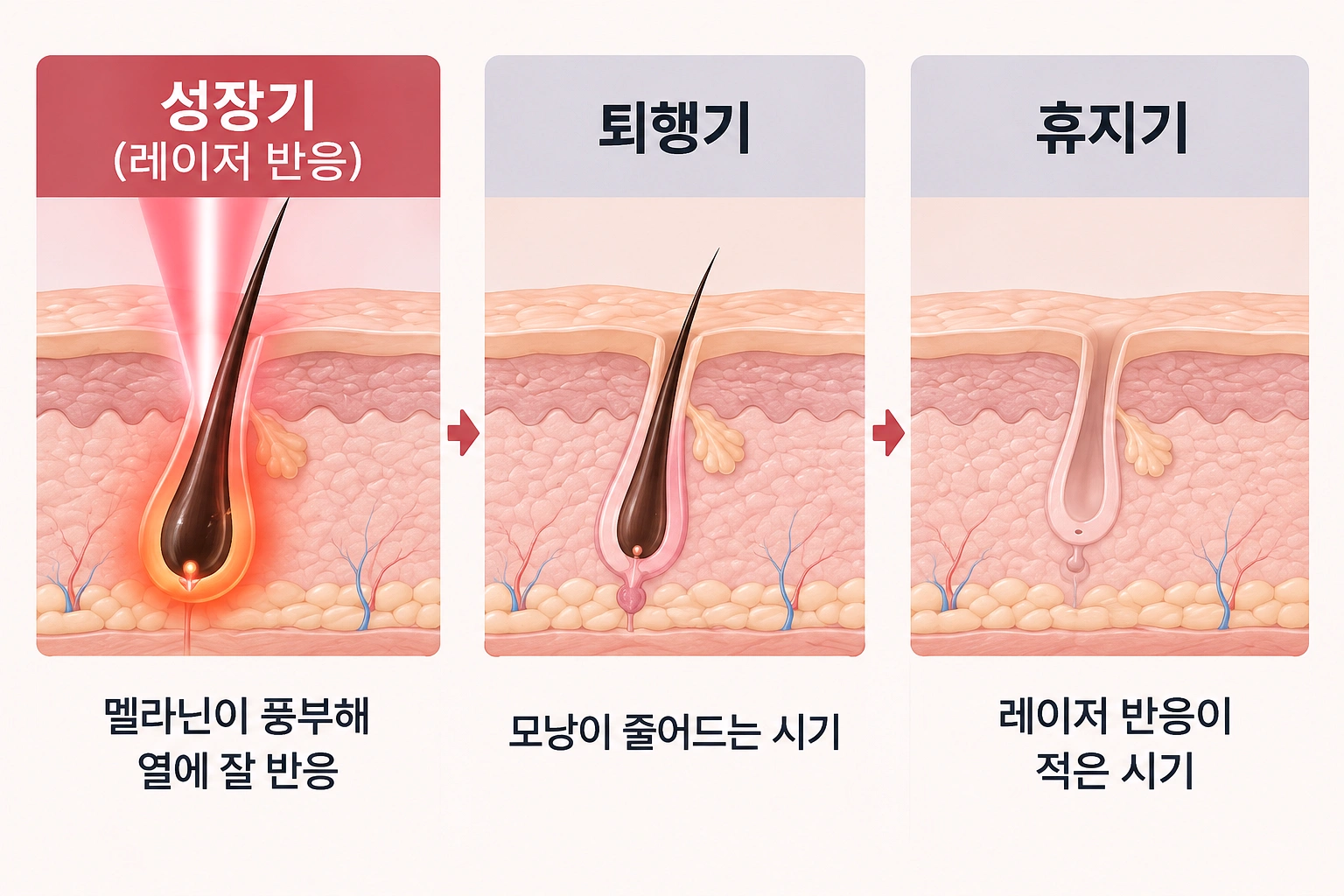 성장기에는 레이저에 반응하고 퇴행기와 휴지기에는 반응이 적은 모발 성장 주기를 비교한 피부 단면 모식도