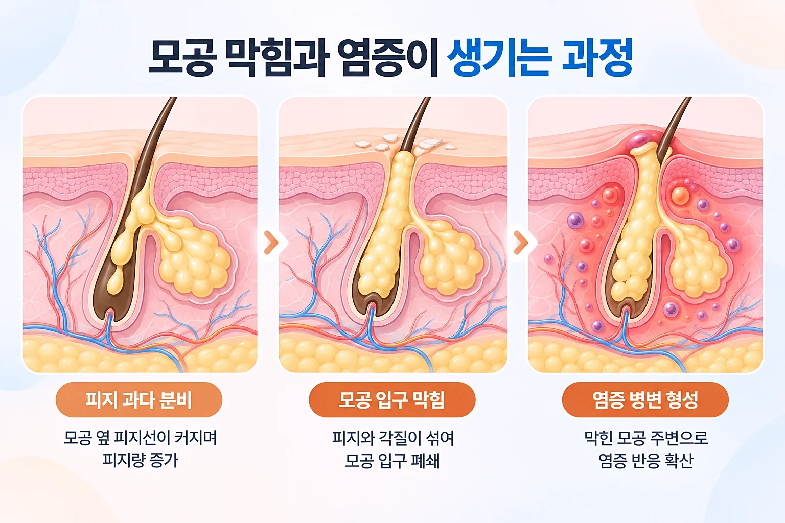 피지 과다 분비, 모공 막힘, 염증 발생 과정을 동일 배율로 나타낸 피부 단면 일러스트