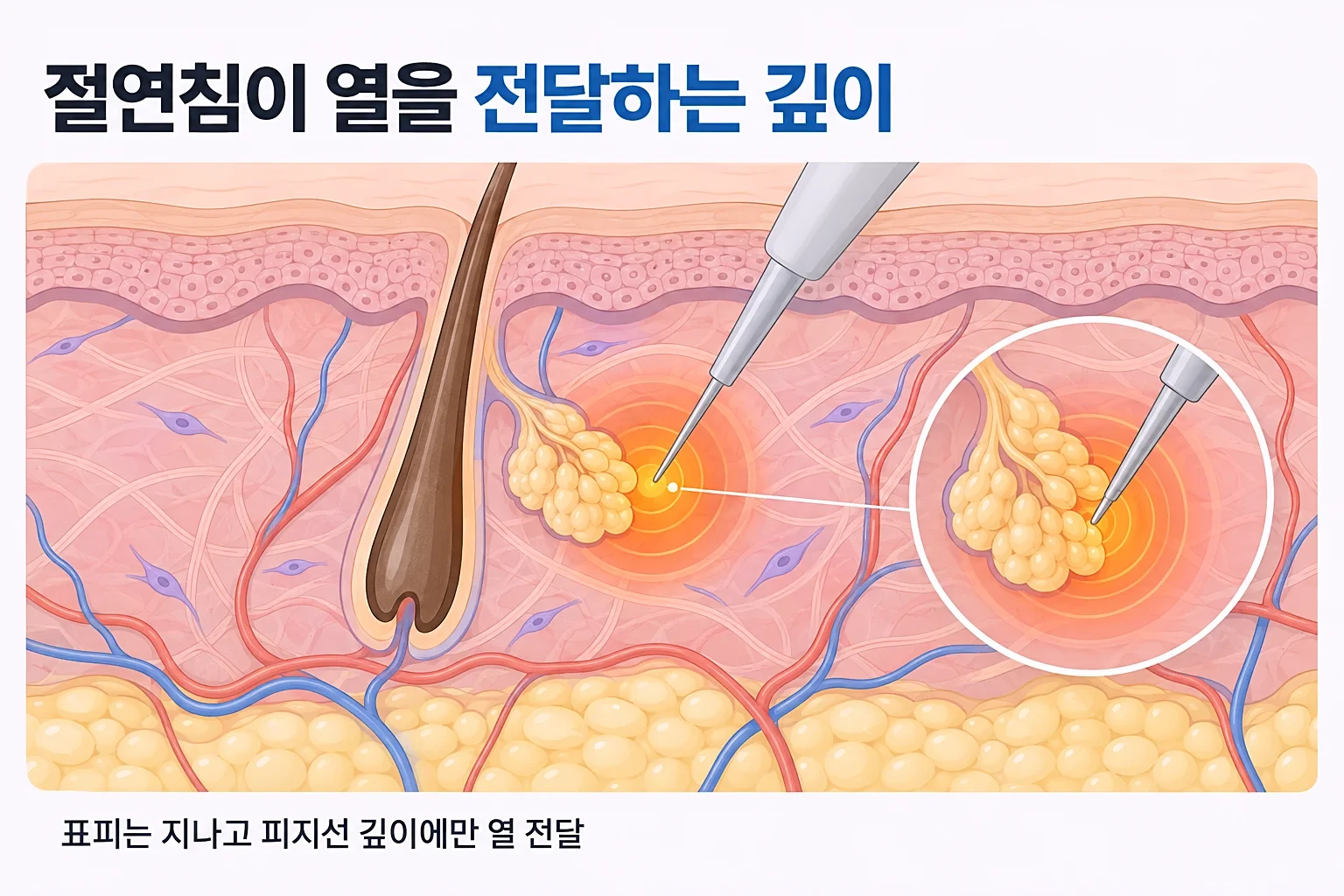 절연 미세침이 표피를 지나 진피 속 피지선 깊이에서 침 끝으로만 열을 전달하는 단면 개념도