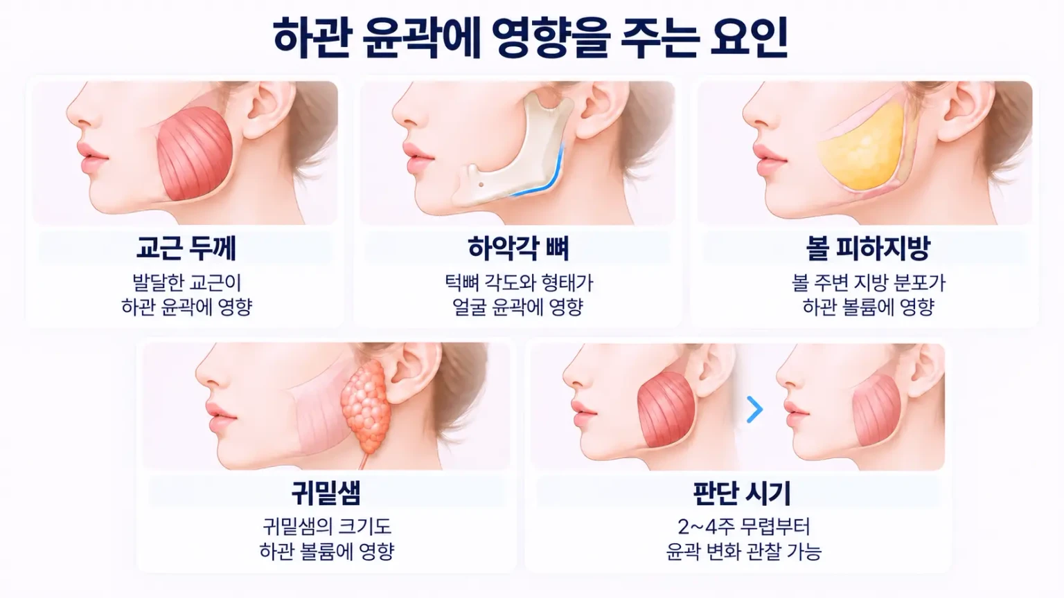 교근 두께, 하악각 뼈, 볼 피하지방, 귀밑샘, 판단 시기를 정리한 하관 윤곽 요인 카드 이미지
