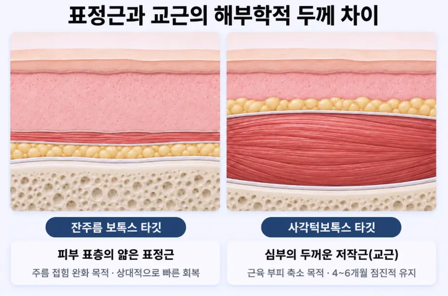잔주름 보톡스 타깃인 표층 표정근과 사각턱보톡스 타깃인 심부 저작근 교근의 해부학적 두께 차이 단면 비교 모식도