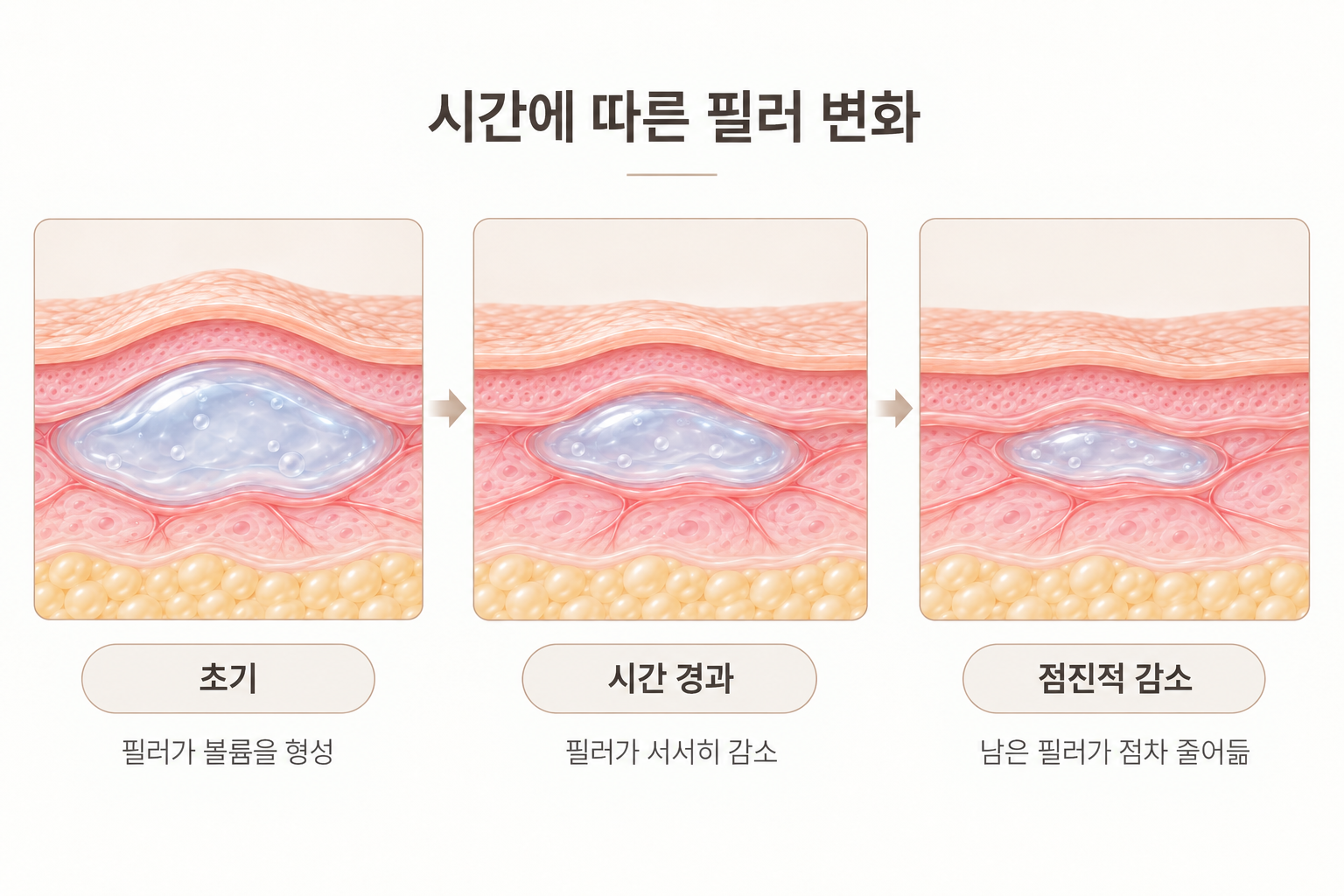 쥬비덤 필러가 시간에 따라 서서히 감소하는 피부 단면 변화