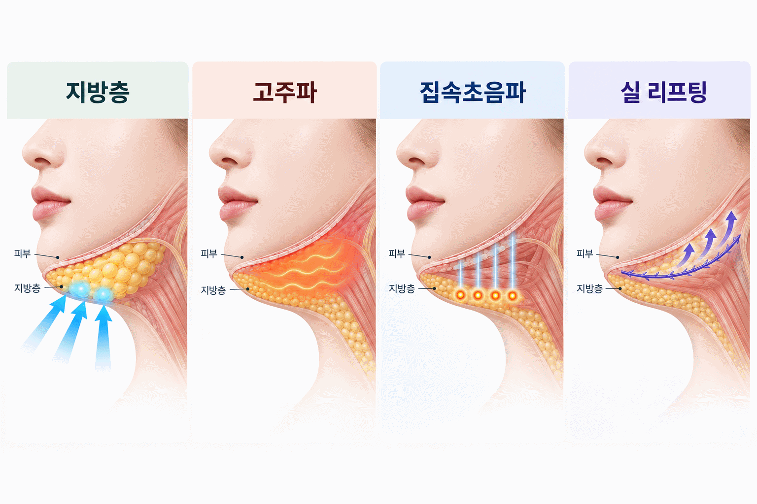 지방층, 고주파, 집속초음파, 실 리프팅의 턱선 작용 방식 비교