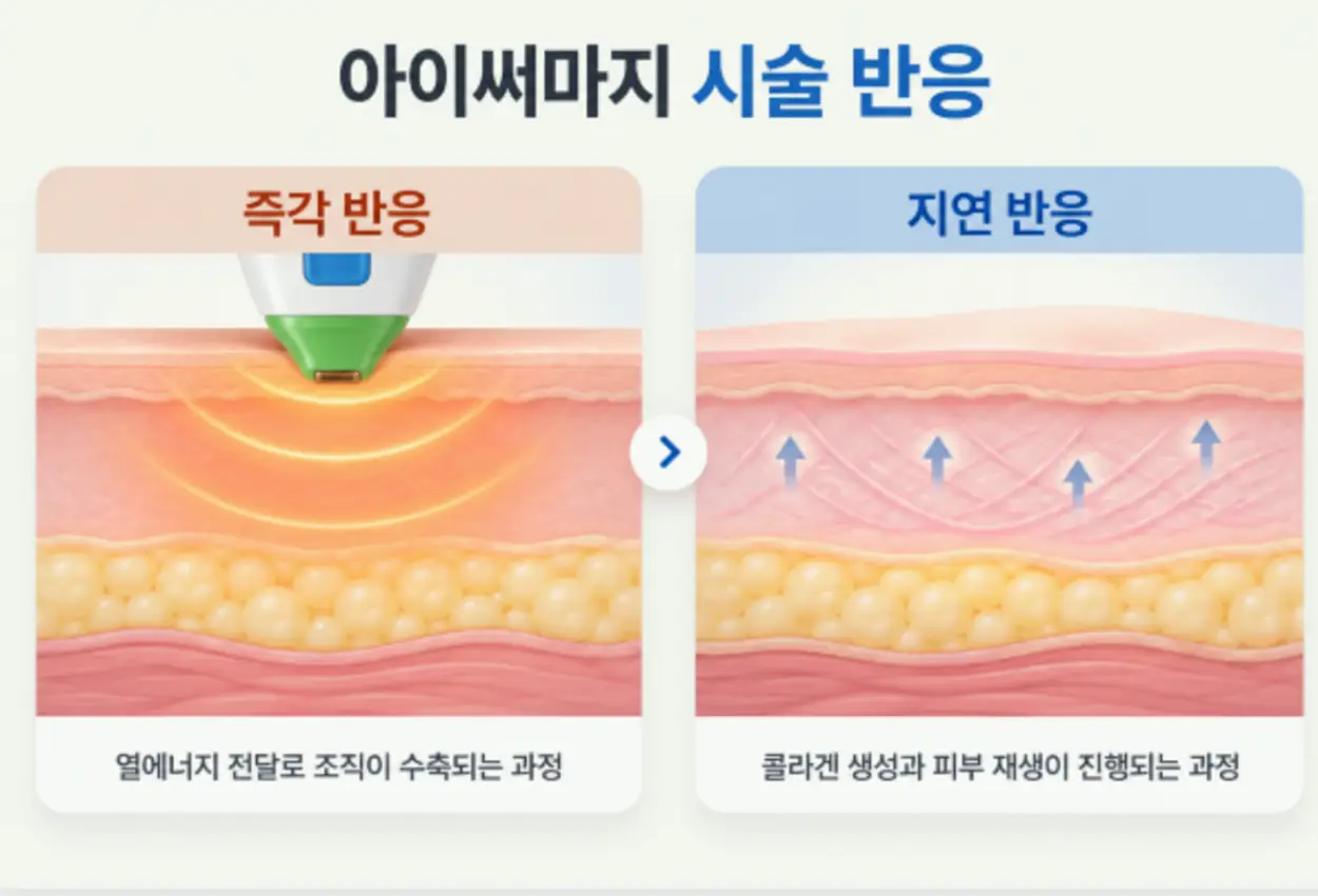 아이써마지 후 바로 피부가 팽팽해지는 이유