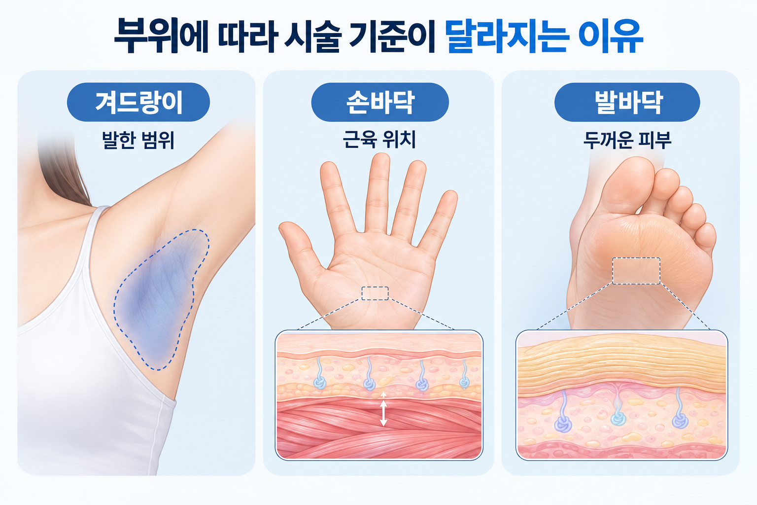 다한증 보톡스 겨드랑이 발한 범위와 손바닥 근육 위치 및 발바닥 피부 두께 차이