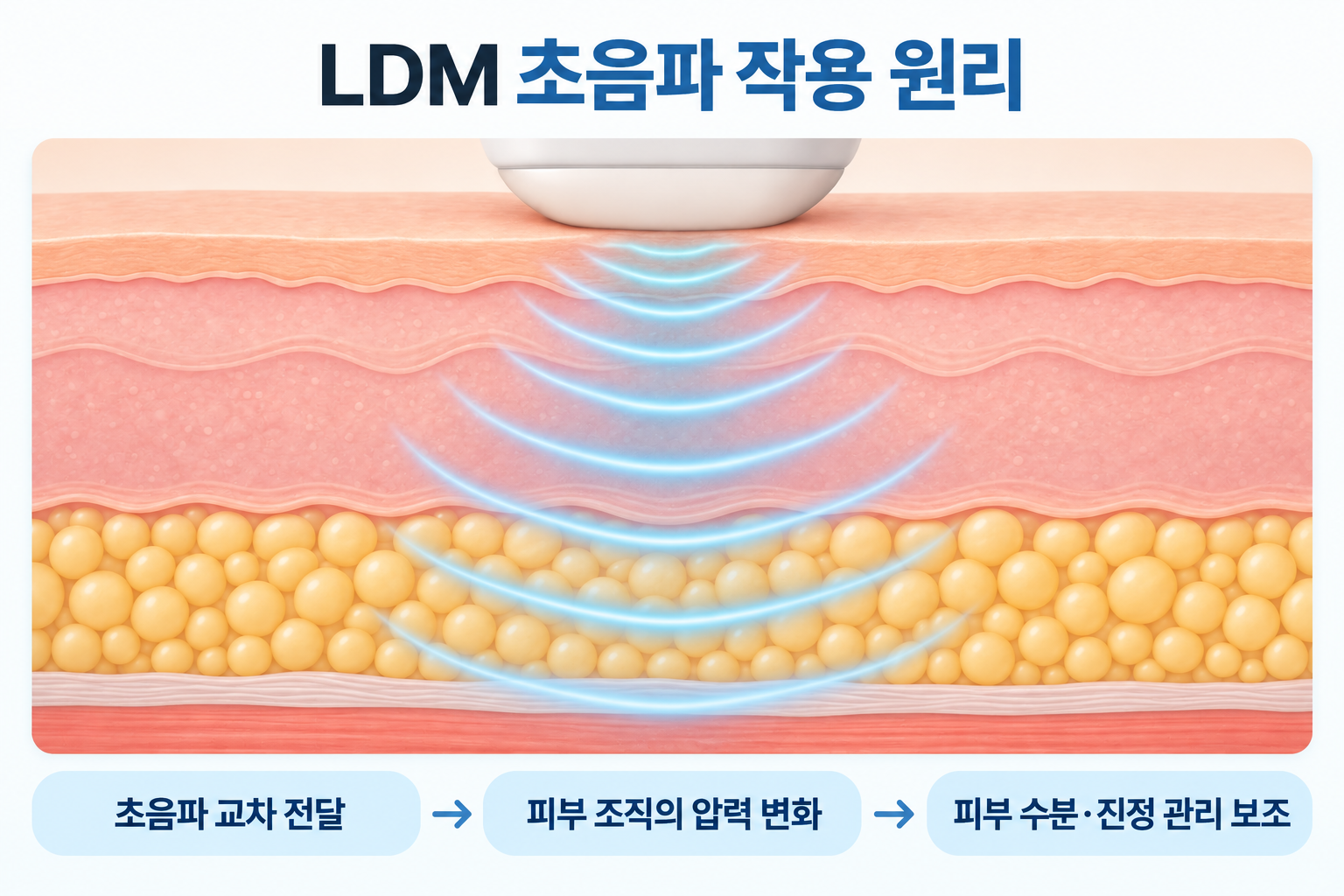 LDM 핸드피스에서 서로 다른 주파수의 초음파가 피부 조직에 교차 전달되어 미세한 압력 변화를 일으키고 수분·진정 관리를 보조하는 과정