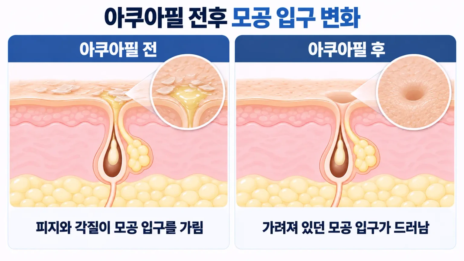 아쿠아필 전후 피지와 각질 제거로 모공 입구가 드러나는 변화를 비교한 피부 단면도
