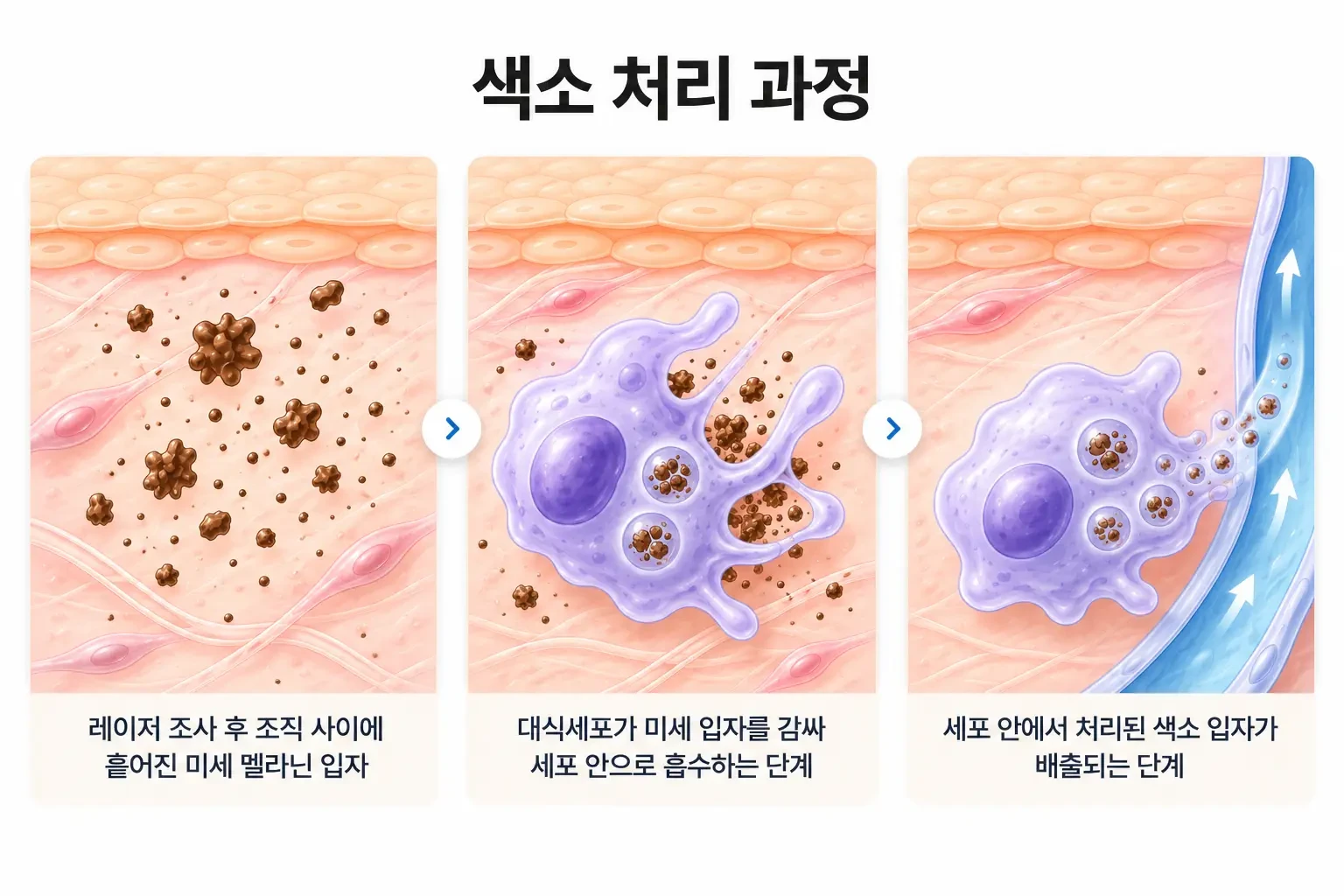 잘게 부서진 멜라닌 입자를 대식세포가 감싸 흡수하고 처리하는 과정을 단계별로 그린 세포 일러스트