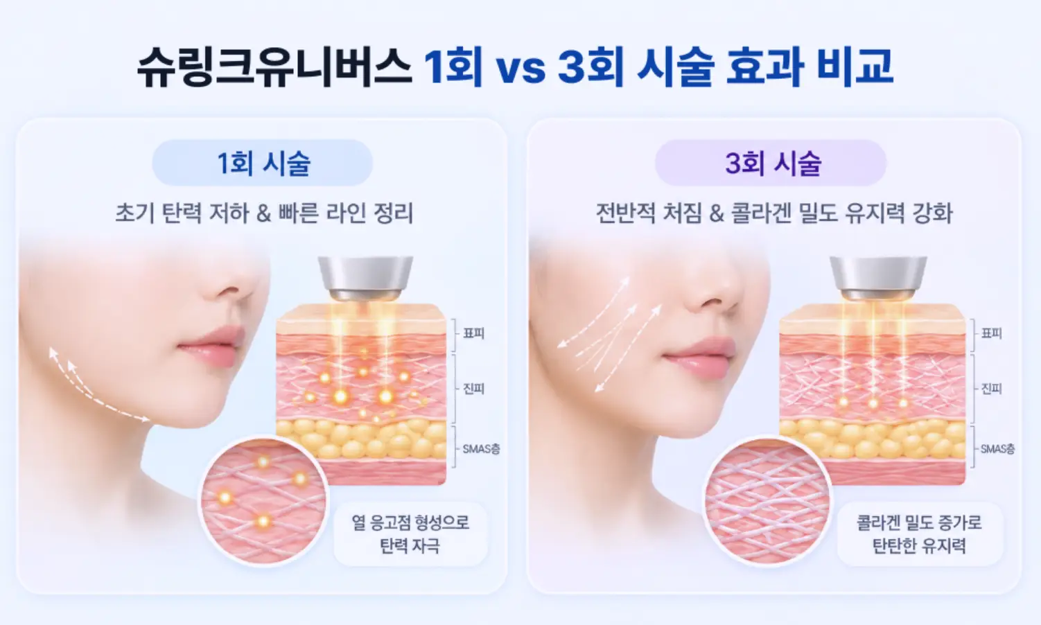 슈링크유니버스 1회 집중 시술의 국소 라인 정돈 및 열 응고점 형성과 3회 누적 시술의 콜라겐 밀도 증가 유지력 비교 다이어그램