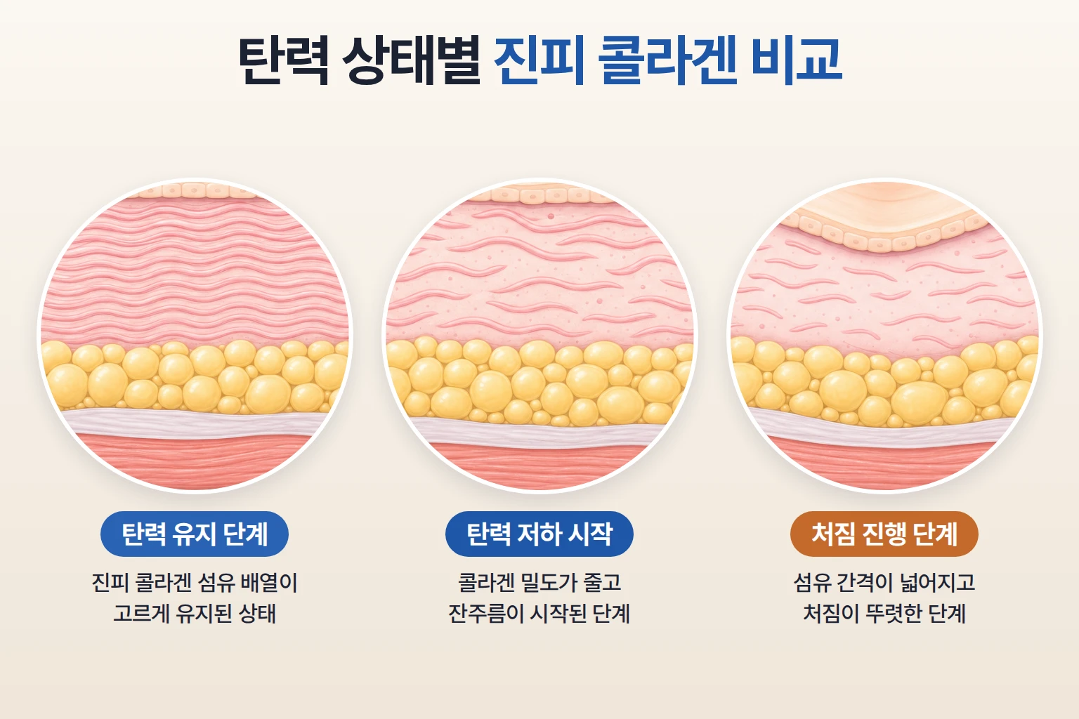 탄력 저하 정도가 다른 세 피부의 진피 콜라겐 밀도와 섬유 배열을 동일 배율로 비교한 단면 모식도