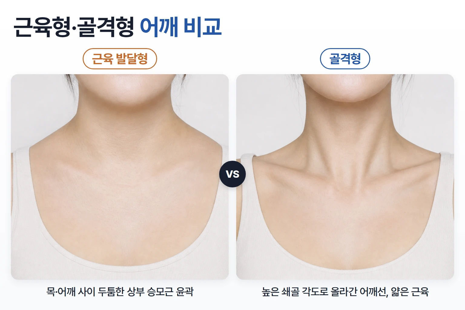 상부 승모근이 두꺼운 근육 발달형 어깨와 쇄골 각도가 높은 골격형 어깨를 앞에서 비교한 사진