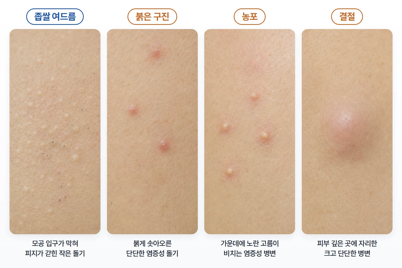 좁쌀 여드름과 붉은 구진, 농포, 깊은 결절의 피부 표면 특징 비교