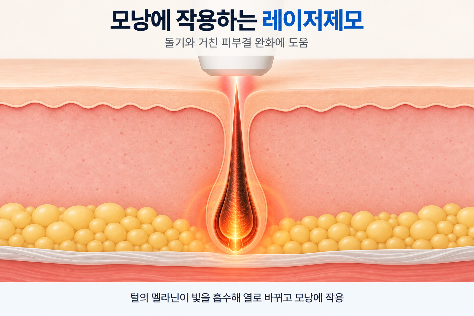 레이저 빛이 털의 멜라닌에 흡수되어 열로 바뀌고 모낭에 작용하는 원리