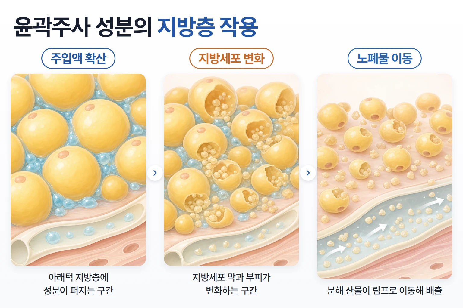윤곽주사 주사액 확산과 지방세포 변화, 노폐물의 림프 이동을 동일 배율로 단계별 비교한 개념도