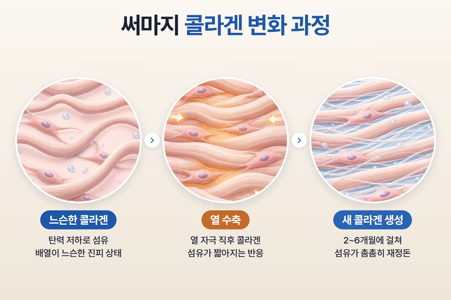 써마지 열 자극 후 콜라겐 수축과 새로운 콜라겐 생성이 이어지는 과정