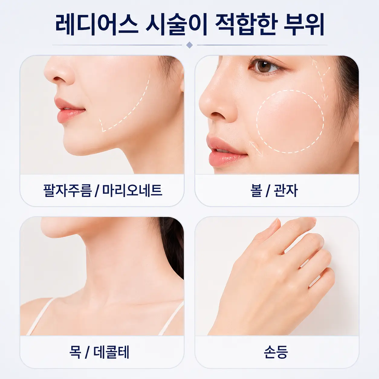 레디어스 효과가 잘 나타나는 부위
