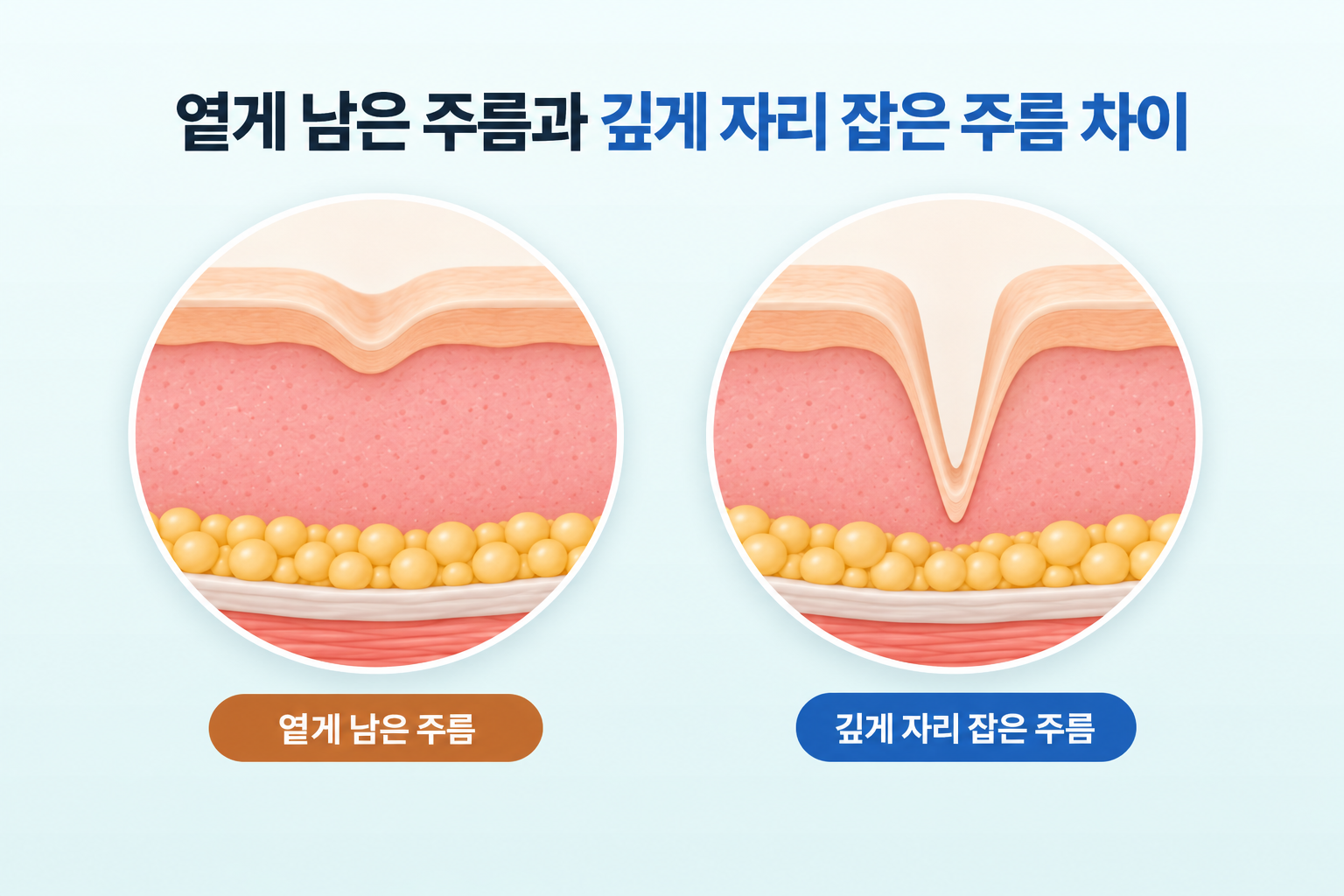 옅게 남은 주름과 깊게 자리 잡은 주름의 피부 단면 차이
