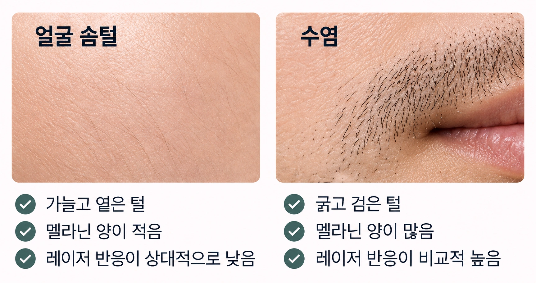 가늘고 옅은 얼굴 솜털과 굵고 검은 수염의 레이저 반응 차이