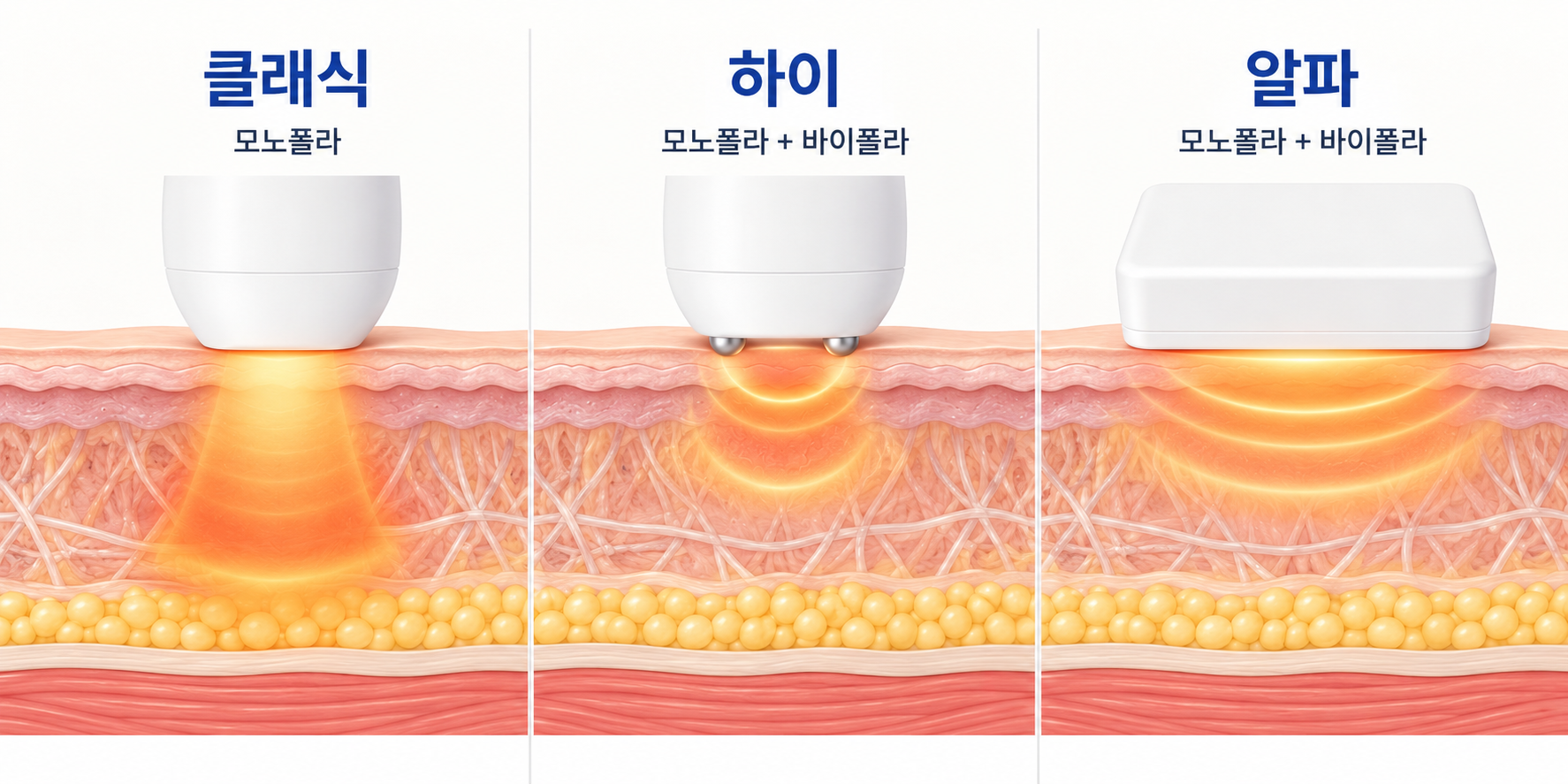 덴서티 클래식 모노폴라와 하이·알파 모노폴라 바이폴라 에너지 전달 범위 비교